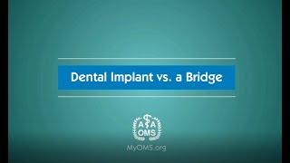 Dental Implant vs. a Bridge