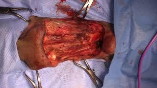 wide excision paw mass including flexor tendons