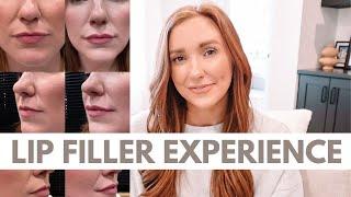 MY EXPERIENCE WITH LIP FILLER | Cost? Pain? Recovery? Was it WORTH IT?!