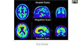 Research connects I Disease-modifying treatments and dementia