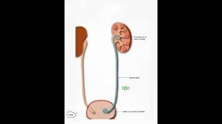 Xray - Bilateral DJ Stent insitu