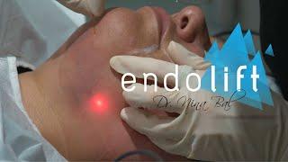 Endolift, The Non Surgical Face Lift Treatment by Dr Nina Bal | Skin Tightening Before and After 