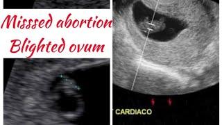 Missed abortion/early pregnancy failure/Blighted ovum/बच्चे की धड़कन ना बनना/absent heart beat scan