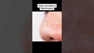 NEW Blackheads removal Dm on instagram for any queries Presence of white/blackheads is called comedo