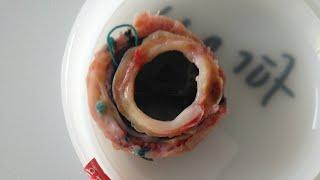 mechanical aortic valve obstruction with ring like Pannus