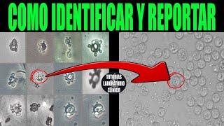 Examen Microscópico de Orina: Leucocitos, Eritrocitos, Células, Bacterias, Cristales, Cilindros ️