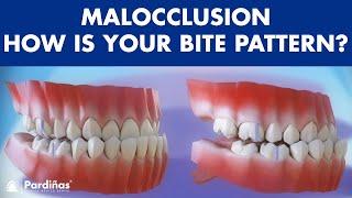 Malocclusion - Bite patterns ©