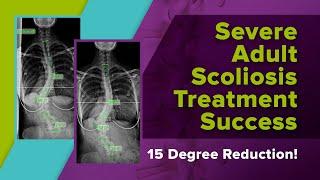 Severe Adult Scoliosis Treatment Success - 15 Degree Reduction!