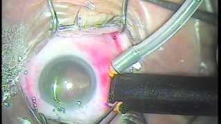 Macular Hole Surgery | MIVS Surgery | Dr Madhusudan Davda | Mumbai Eye Retina Clinic