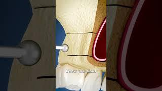 Sinus Lift Surgery Explained 