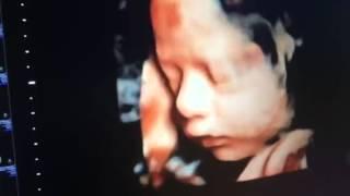 AMAZING HD LIVE 4D ULTRASOUND 29 WEEKS