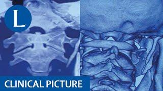 Eagle syndrome cause throat pain in submandibular region