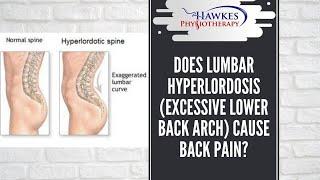 Does Lumbar Hyperlordosis (excessive lower back arch) cause back pain?