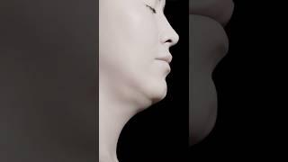 Neck lift, deep neck lift and neck contouring ⭕️  KAMINSKYI