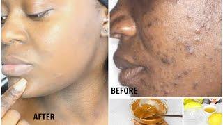 HOW TO CLEAR  DARK SPOTS & HYPERPIGMENTATION FAST + CHEAP | RESULTS IN 17 DAYS