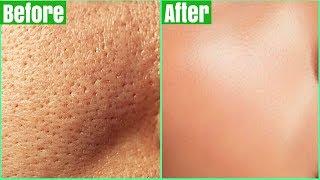 How To Get Rid Of LARGE PORES PERMANENTLY (100% Works)| Shrink & Get Clear Glass Skin Naturally
