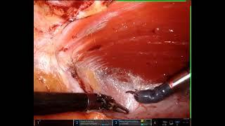 Robotic eTEP incisional hernia repair