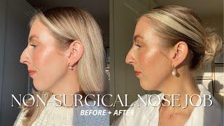 I GOT A NON-SURGICAL NOSE JOB FOR OUR WEDDING DAY| Katie Peake