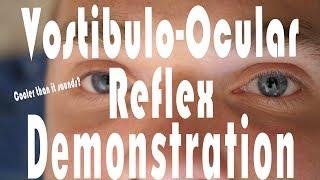 Caloric Testing COWS Vestibulo-Ocular Reflex Hack - It Works!