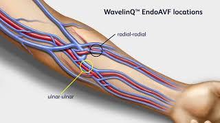 BD WavelinQ™ EndoAVF System Procedural Animation