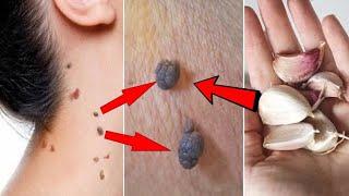 Remove skin tags in 1 night |  Amazing Skin Tag Removal Remedies |  How to remove skin tags.