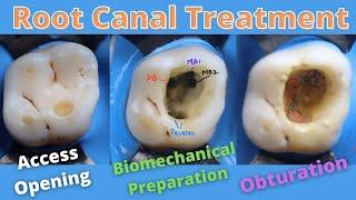 Root Canal Treatment in Maxillary First Permanent Molar 🟠 How to locate Mesiobuccal Canals(mb1,mb2)