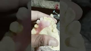 2 Unit Removable Partial Denture By Haider #rpddentalprocedure #dentures