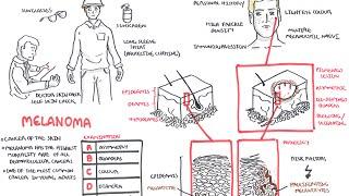 Melanoma - Overview (signs and symptoms, pathology, risk factors, treatment)