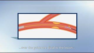 FFR and cRR measurements with the TruePhysio® Microcatheter & VivoCardio® CPM system