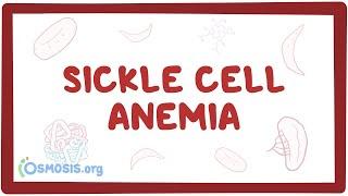 Sickle cell anemia - causes, symptoms, diagnosis, treatment & pathology