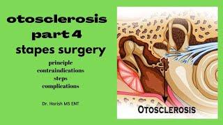 otosclerosis part 4/4 | stapedectomy | principle, steps, complications | MBBS - ENT