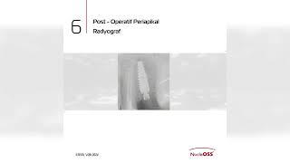 Clinical Case - Immediate Loading in Single Tooth / Dr Tolga Pekperdahcı and Prof. Dr Doruk Koçyiğit