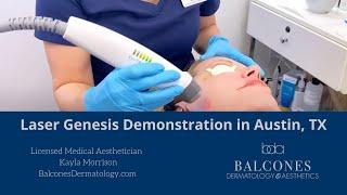 Laser Genesis Treatment Demo | Balcones Dermatology & Aesthetics |Austin, TX | Ph:512-459-4869