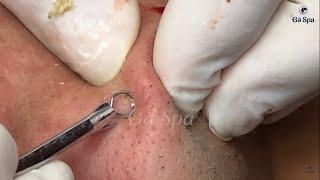 Full Blackhead Popping Video - HOT 2019 - Part 3 - END