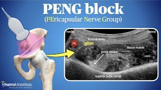 PENG Block (Pericapsular Nerve Group Block)