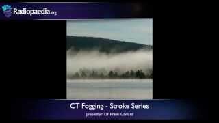 Stroke: Fogging phenomenon on CT - radiology video tutorial