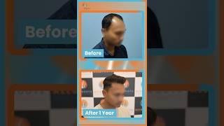 Hair transplant results after 1 year | 2740 grafts transplated | Dr Alok Sahoo