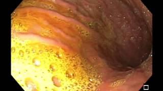 Bile Reflux Gastritis - 2