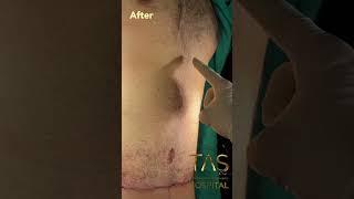 Tummy tuck surgery by Dr.Tas