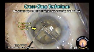 CataractCoach 1360: cross chop technique