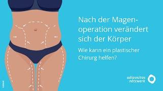 Nach der Magenoperation verändert sich der Körper. Wie kann ein plastischer Chirurg helfen?