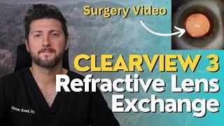 Refractive Lens Exchange (RLE) Surgery with the Clearview 3 Lens