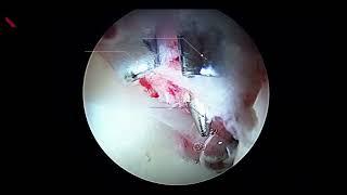 Surgical Technique - Puncture Capsulotomy Technique During Hip Arthroscopy