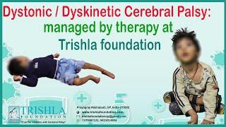 Dystonic / Dyskinetic Cerebral Palsy: managed by therapy at Trishla foundation