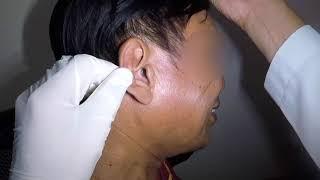 Watch How to Remove Man's Earwax Plug with MD Scope