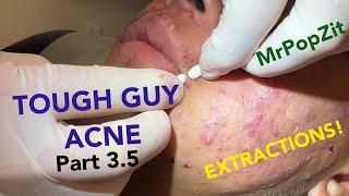 Tough guy acne part 3.5! Continue his extractions before he starts isotretinoin. Previous pops below