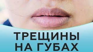 Трещины на губах. Как избавиться от трещин на губах