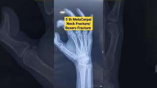 5 th MetaCarpal Neck Fracture / Boxers Fracture ...Dr Sai Chandra..Knee N Shoulder Surgeon