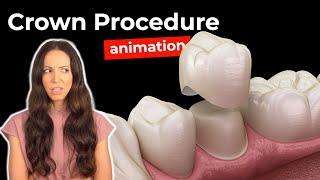 Dental Crown Procedure at the Dentist