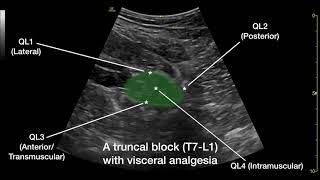 The Anterior Quadratus Lumborum (QL) Block